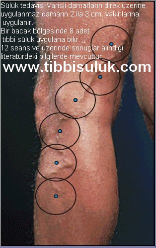 medicinalleech's tweet photo. Tıbbi sülükler ile #Varis tedavisi örnek uygulama noktaları.
#sülüktedavisi #tıbbisülük #hirudoterapi https://t.co/HgObfySKRe