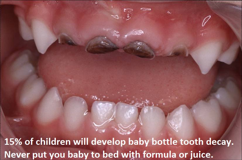 HowardFarran's tweet photo. 15% of children will develop baby bottle tooth decay. Never put you baby to bed with formula or juice. https://t.co/EHNazPSJqV