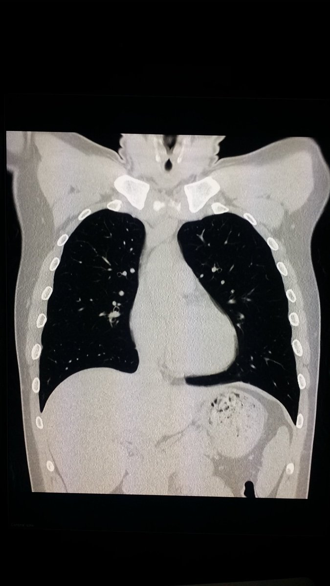 steleRAD's tweet photo. #Normal #Multidetector #CT #scan of #chest shows #heart & #lungs
in a #patient with chest #pain after #car #accident https://t.co/HKOofqpu6W