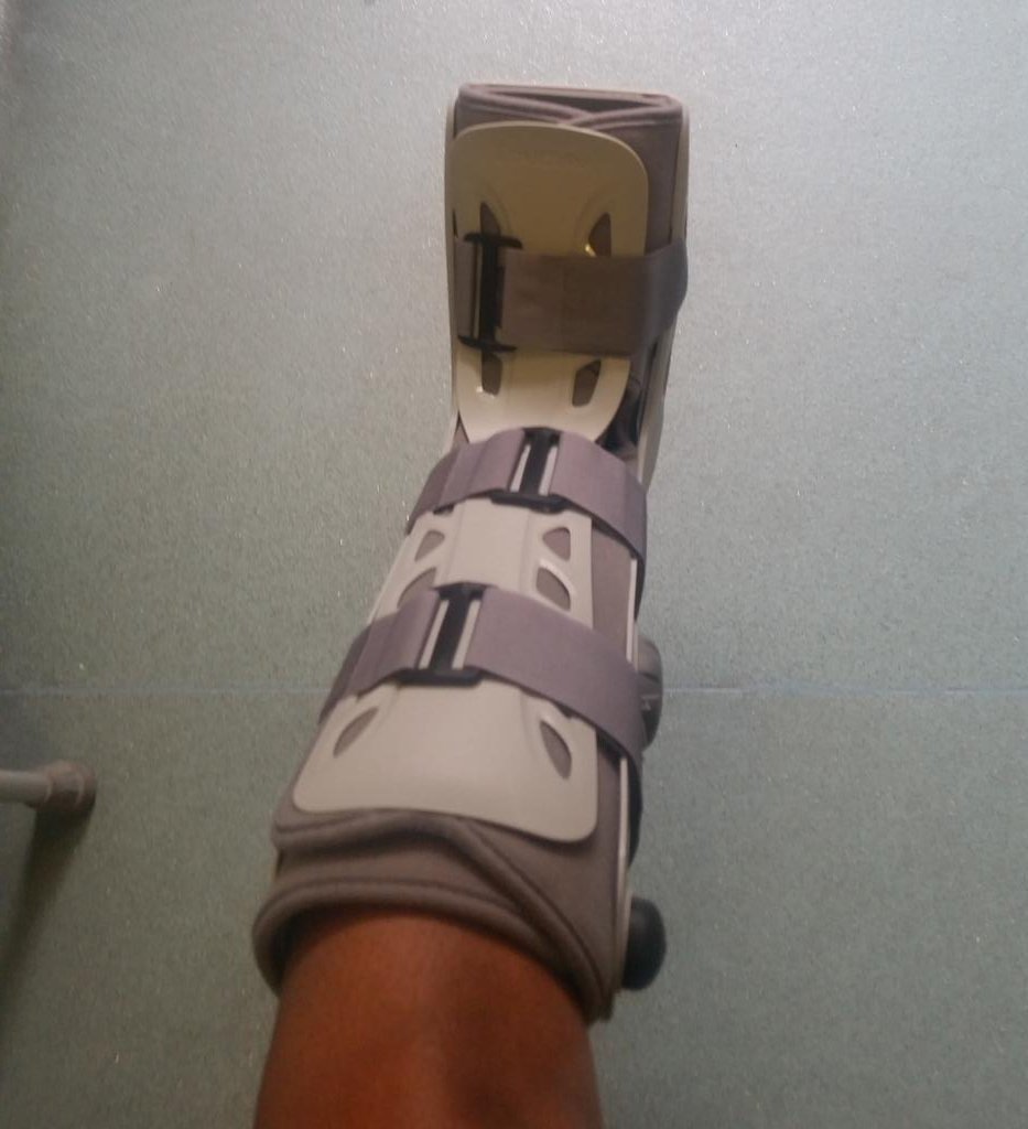 jus2gud4u's tweet photo. Afta 12wks my cast came off 2dy 😆. Thinking of a foot tattoo cover the scar #lisfranc #brokenfoot #airboot #happy 👣 https://t.co/VbXkmvWZSZ