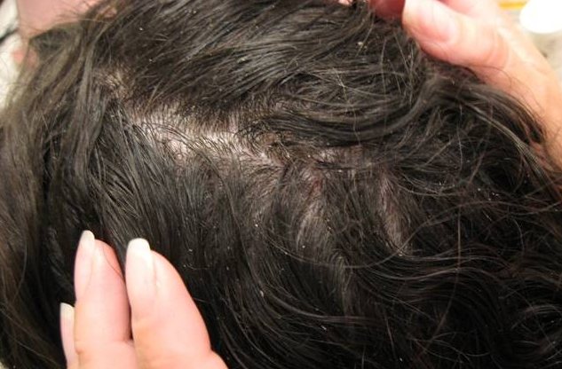 Tinylocks's tweet photo. Keep away your confusion about #headlice and #removal. https://t.co/kvt1K1XPsy https://t.co/DJy3fGKVGy