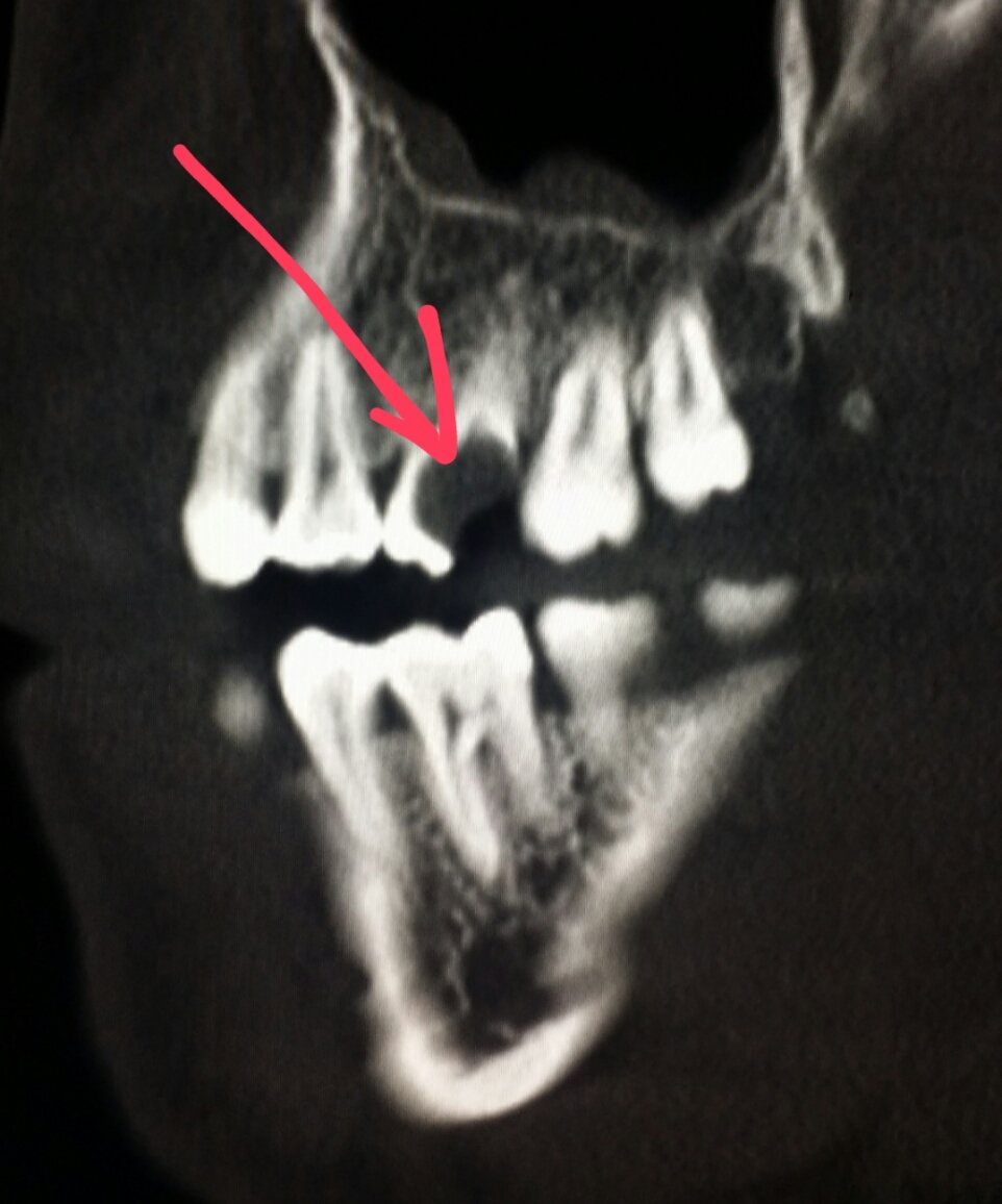 steleRAD's tweet photo. #Multidetector #CT of the #face shows a large #dental #cavity in a #patient
with #pain after #trauma. #radiologist https://t.co/P9plgKZ2iv