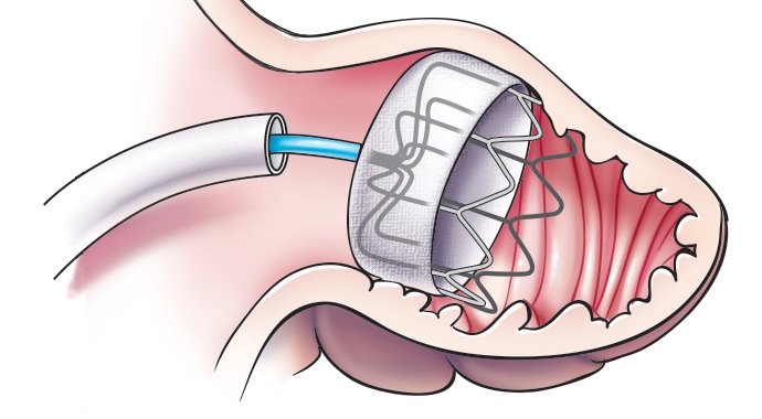 CleClinicMD's tweet photo. New device looks to be a vital 2nd-line therapy for stroke prevention in selected #AFib pts https://t.co/ROP84DshMj https://t.co/KIEoPlmci8
