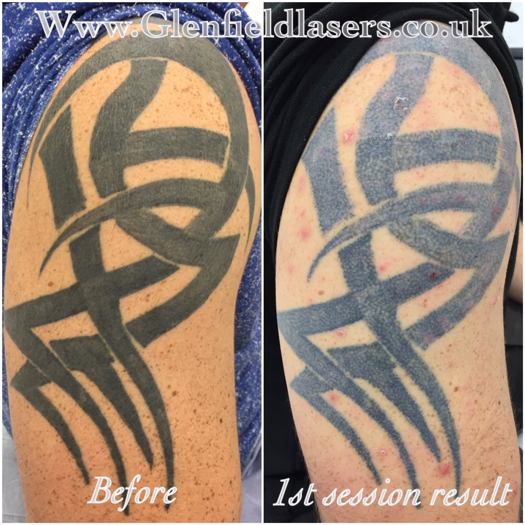 Laser Tattoo Removal Process Explained  My First Session  YouTube