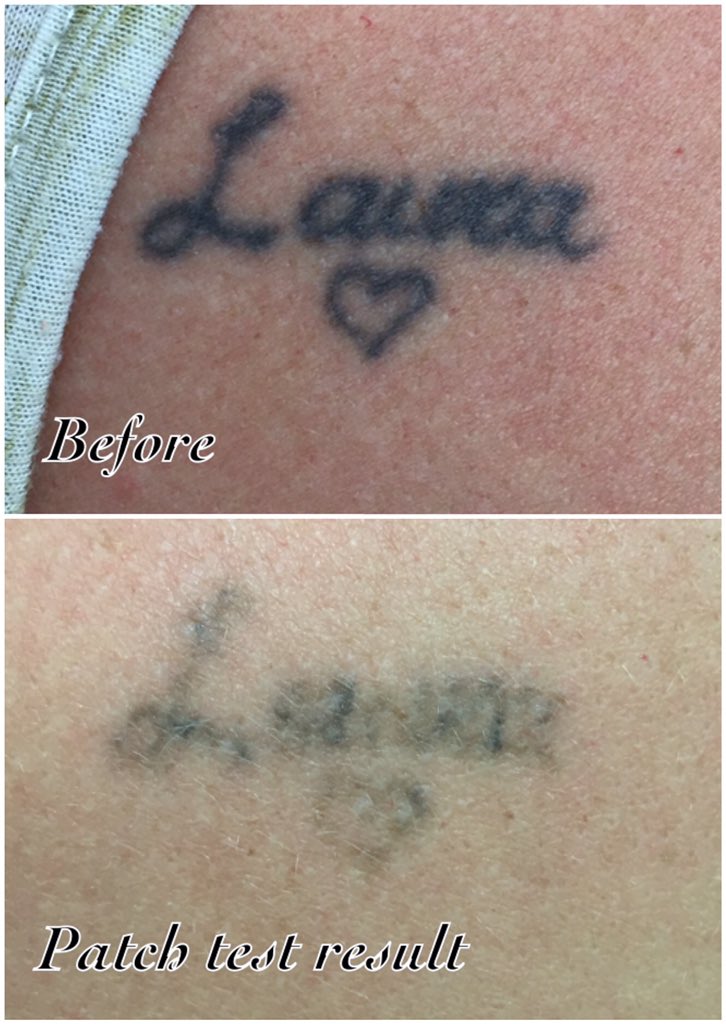 Laser Tattoo Removal Ohio | Lima, Celina and Findlay, OH