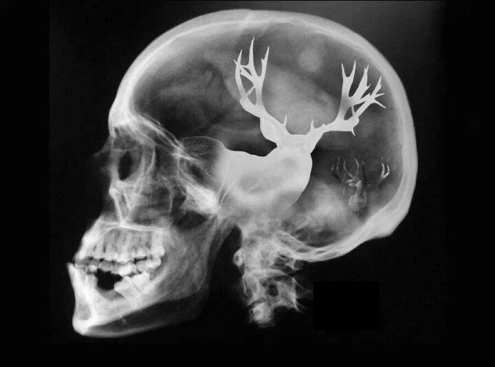 BmNation's tweet photo. Doc said I had a bad case of BUCK FEVER! https://t.co/jVR8zEWxid