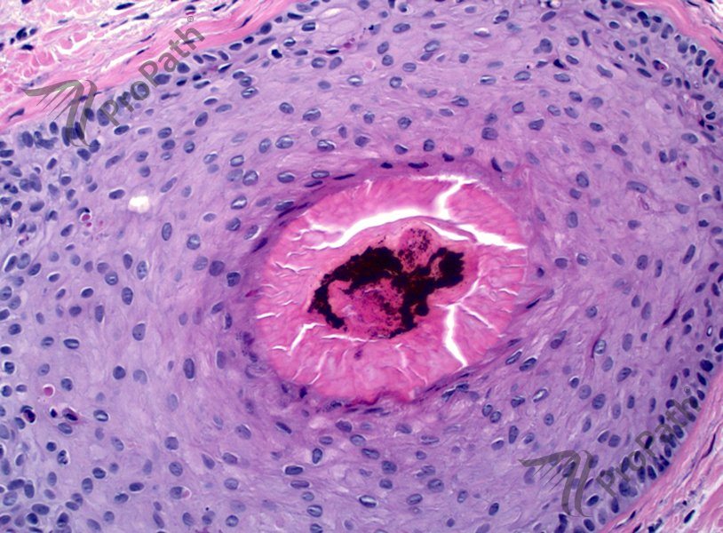 RyanHickMD's tweet photo. #Trichotillomania #clue: increased #catagen & #telogen #hair with #pigment casts. #alopecia #dermpath #dermatology https://t.co/jgNgbxf6E6