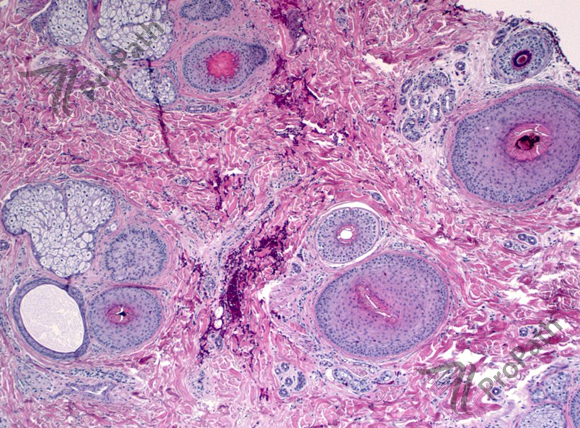 RyanHickMD's tweet photo. #Trichotillomania #clue: increased #catagen & #telogen #hair with #pigment casts. #alopecia #dermpath #dermatology https://t.co/jgNgbxf6E6
