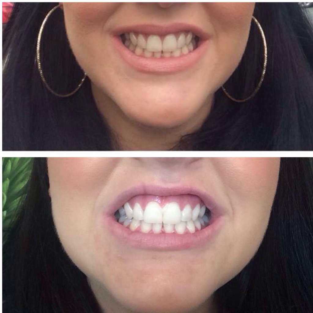 SmileStudioTM's tweet photo. Book now for £60 or book with a friend and pay £50 each! #10shadeswhiter https://t.co/RY9XL6qwi8