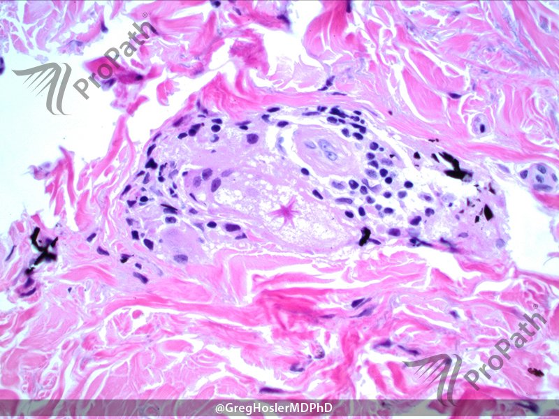 GregHoslerMDPhD's tweet photo. No, the #AsteroidBody is not from #sarcoidosis, not #sporotrichosis, but a measley #tattoo. #Dermpath #pathology https://t.co/4EZuvib65I