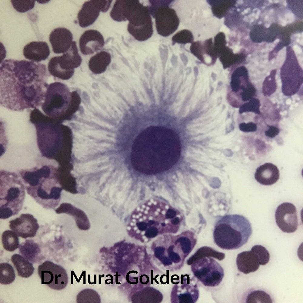 Despite the bad hair day, this mesothelial cell from pleural fluid #cytology is benign. #pathology #pathArt #science