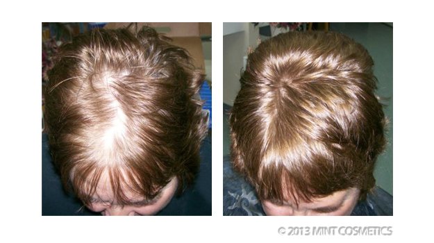 Groei360's tweet photo. Hair today, gone tomorrow. Hair again soon? Chk the #breakthroughs in #HairLossTreatments @ https://t.co/klIiZvmtcE https://t.co/uBctr5NDLV