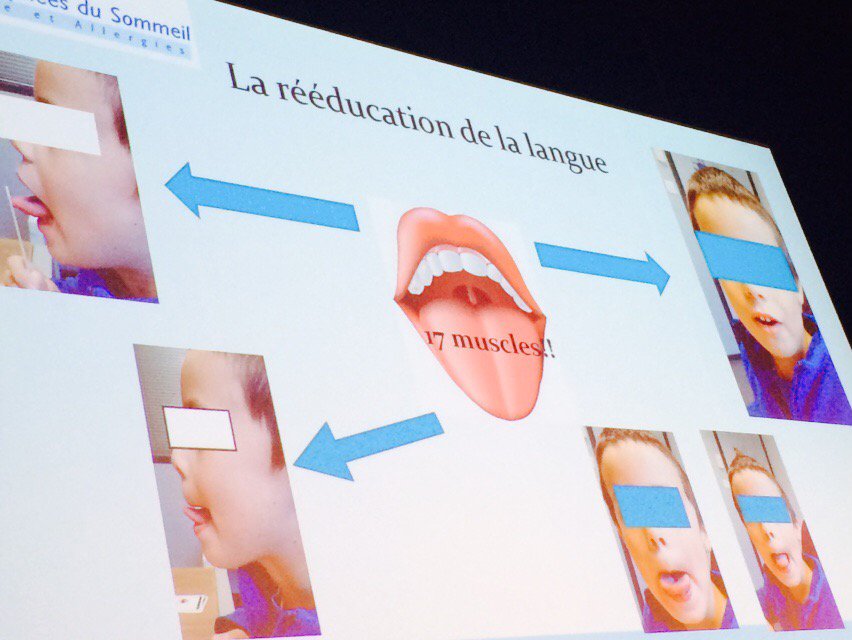 SapeneM's tweet photo. #JAS2015 #apnees #sommeil #enfant #reeducation #linguale #kinésithérapie par @ManoukianMeryl @Allianceapnees https://t.co/AcIJMSspKB