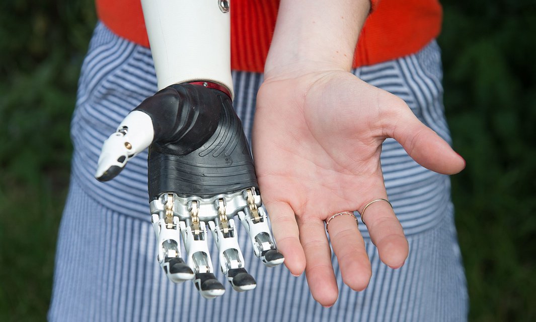 bophcharity's tweet photo. UK’s first patient to receive a lifelike bionic hand! - https://t.co/7J63shCfJW via @guardian #bionic https://t.co/QnICqPoC6n