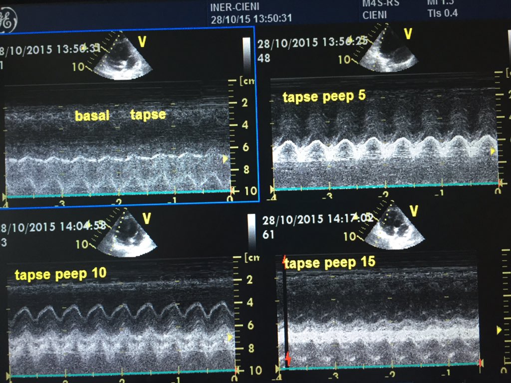 PleuralPOCUS's tweet photo. TAPSE with different levels of PEEP #FOAMcc #FOAMed #FOAMus @Periop_Echo https://t.co/Ddd5odM7CX