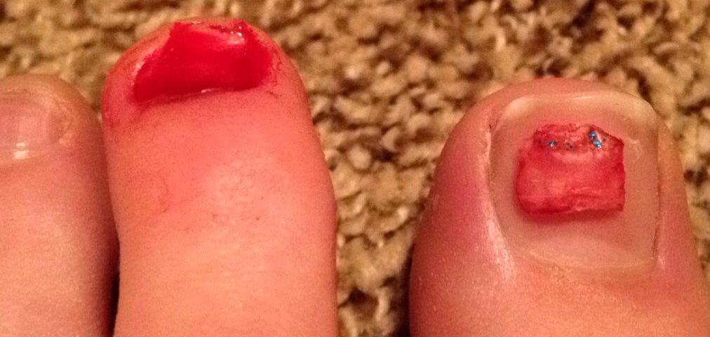 lovinthegame_35's tweet photo. It just never fails... Here's to toenail number whoknowsanymore....
#LifeOfAnAthlete #ItsNormalRight https://t.co/612U6YErat