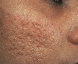 pimplesg's tweet photo. #AcneTreatment
Acne Treatment | Acne Scar Treatment | Pimple Scar Treatment | Pimple.sg
https://t.co/Fd89oqgDFv https://t.co/cfXmRqhXLI