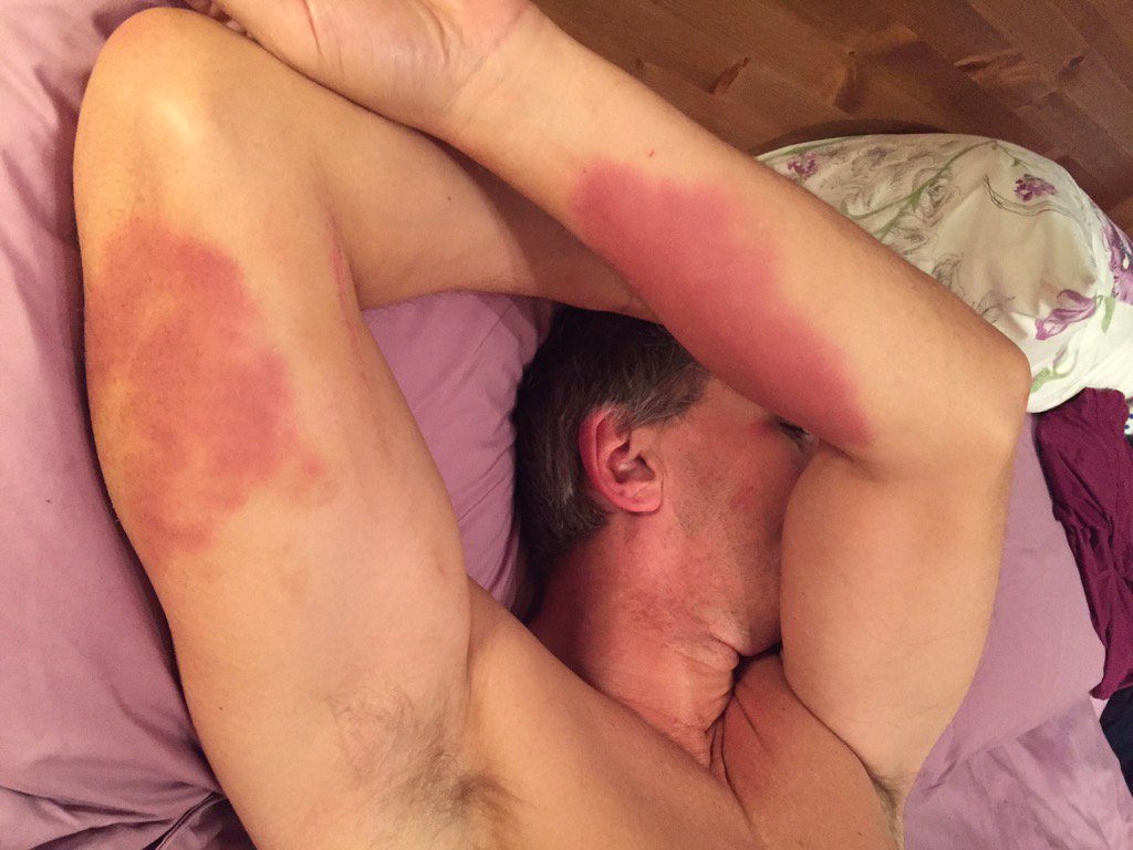 srankie's tweet photo. Think @stephenrank took a bit of a battering last night. #rugby #backformoretomorrow https://t.co/loVKXzNpAM