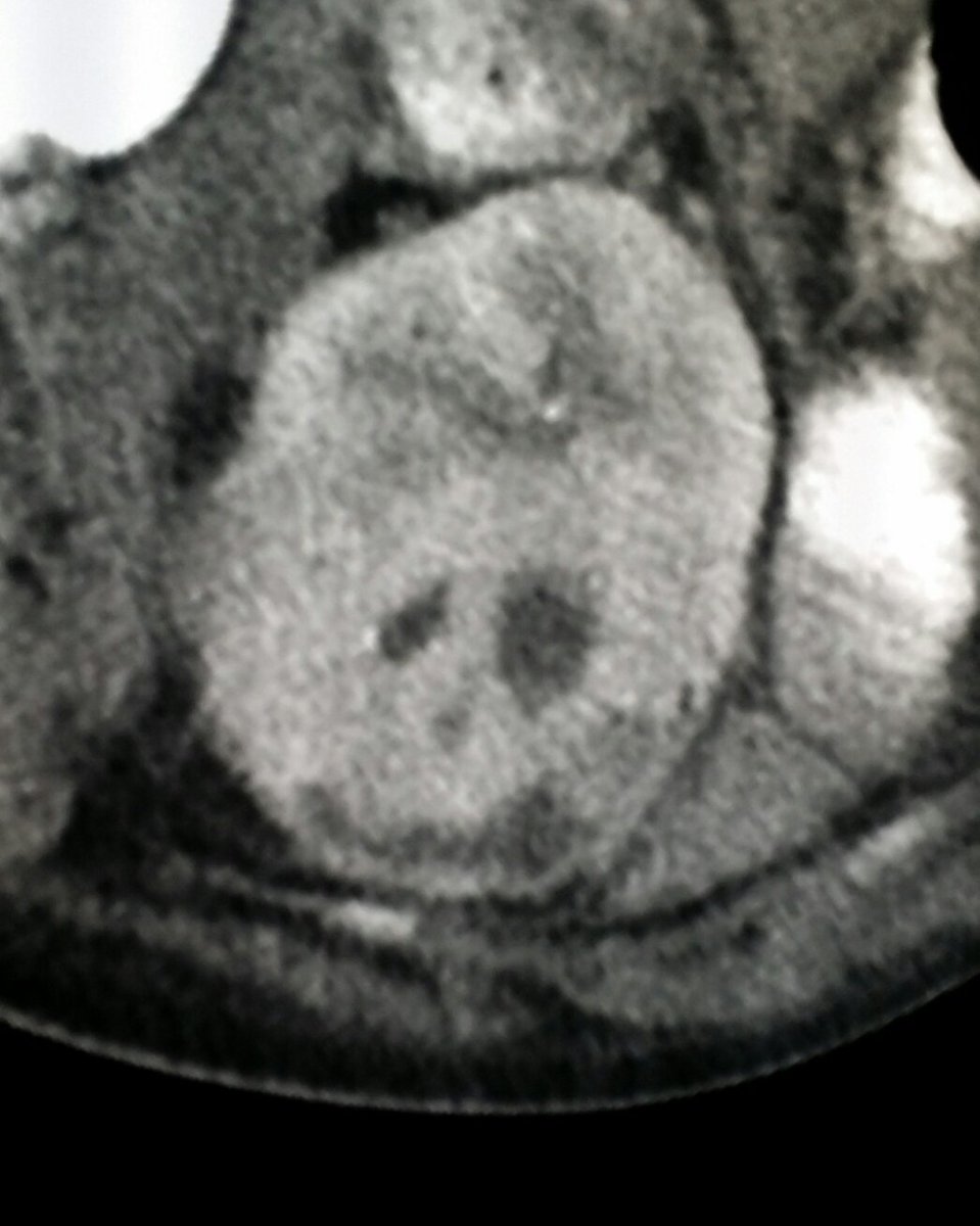 steleRAD's tweet photo. #Multidetector #CT of #abdomen shows #infection in #kidney in
#patient w/ #fever & #pain. #Halloween #jackolantern https://t.co/O4Xw5TCamP