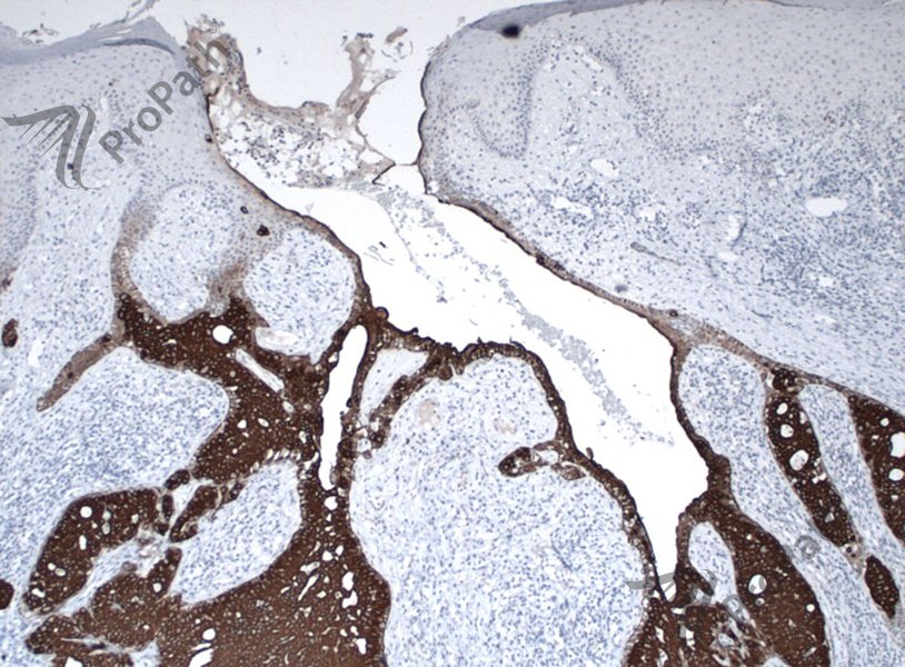 RyanHickMD's tweet photo. #CK7 and #GCDFP15 #immunohistochemistry https://t.co/vQG3nCR88B