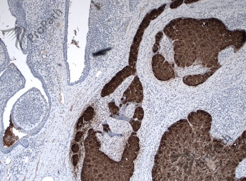 RyanHickMD's tweet photo. #CK7 and #GCDFP15 #immunohistochemistry https://t.co/vQG3nCR88B