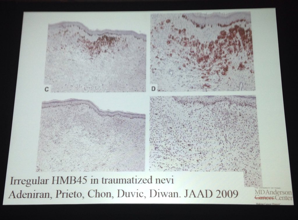 VishwasParekh's tweet photo. Dr Prieto: Irreg hmb45 expression not always evidence of malig. Can be seen in traumatized nevi #ASCP2015 #dermpath https://t.co/rnIuLHlSoR