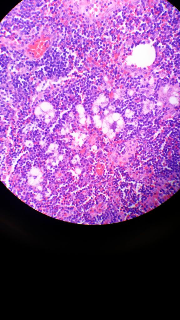 sannere's tweet photo. Why you shouldn't lipoblast hunt-pancreatic lymph node for adeno @mvmd0908 @JMGardnerMD https://t.co/w0VPxsekXb