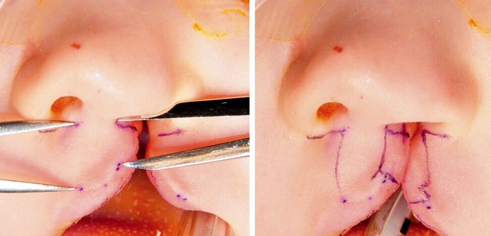 danielzliu's tweet photo. In #plasticsurgery, every mm matters:
Pennant Flap in unilateral #cleftlip
https://t.co/cOr6vDMxlk @prsjournal https://t.co/3XJIIZSqKP