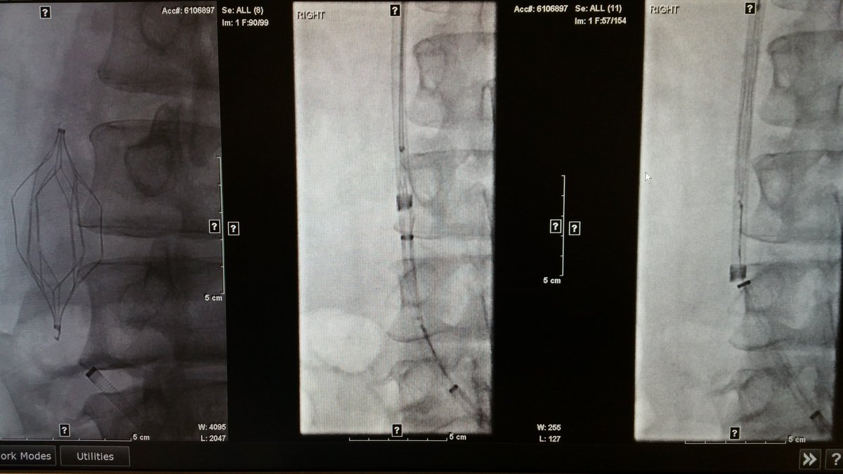 kmadass's tweet photo. Another day, another filter out @arslanmd @jtass6 #irad #LasersAreCool. Keep them coming. https://t.co/jUlkVQtoQw