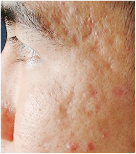 pimplesg's tweet photo. #SolutionforAcne
Deep Pimple Scars | Deep Pimple Scars Treatment | Acne Scar Treatment
https://t.co/AWn9xeh0XV https://t.co/5vwScIDFQa