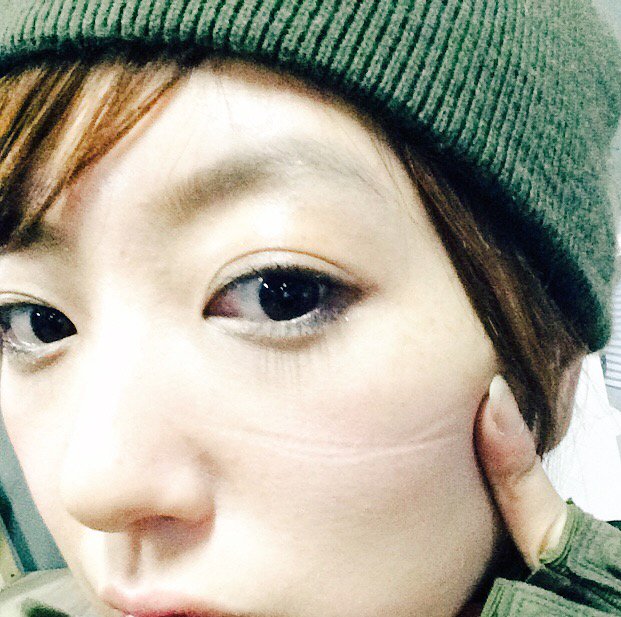 小倉遥 顔がむくんでる 5分くらいマスクしただけで跡がが T Co Edjhpm4jaq
