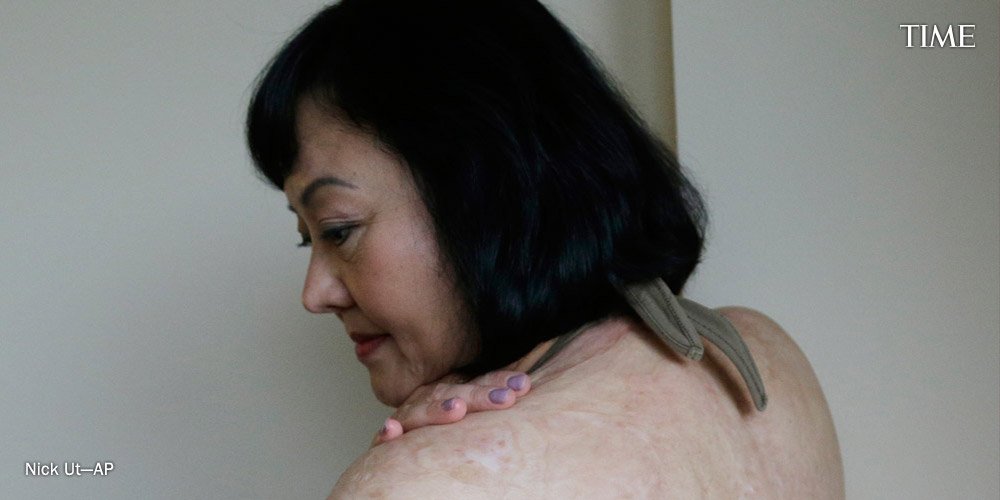 TIME's tweet image. Vietnamese ‘Napalm Girl’ undergoes laser treatments to heal 43-year-old wounds ti.me/1XGmnY0