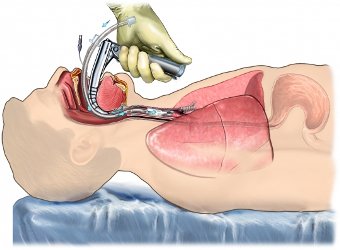 Endotracheal Intubation and Ventilation medicalce.com/endotracheal-i…  retweet please