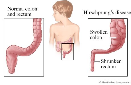 Hirschsprung Hastalığı genetikhastaliklar.wordpress.com/2015/10/31/hir…
