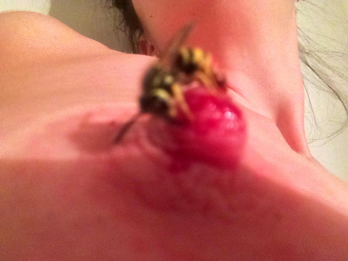 I think a bee stung her fucking lip
