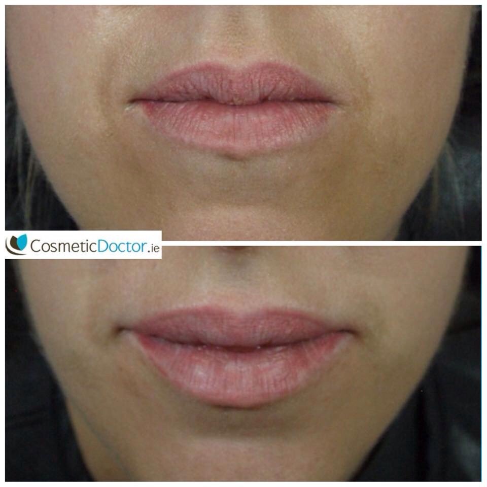 DRLISAFAY's tweet image. Get natural, fuller lips today. Book your consultation with @DRLISAFAY 01-2000500.