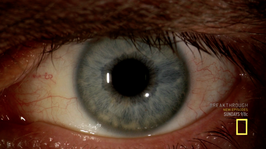 Here's a closer look at Dr. Ian Crozier's Ebola-infected eye, causing ...