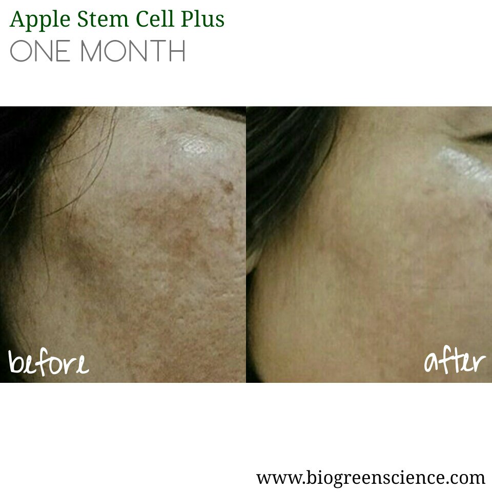 BiogreenScience's tweet photo. One month consuming Apple Stem Cell Plus. Freckles and wrinkles are dissolving. 

#biogreenscience #testimony https://t.co/tMjs45dVA2