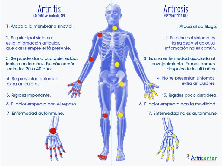 CENTROFISIOS's tweet photo. Descubre las diferencias entre artrosis y artritis https://t.co/amFvJv7UsW