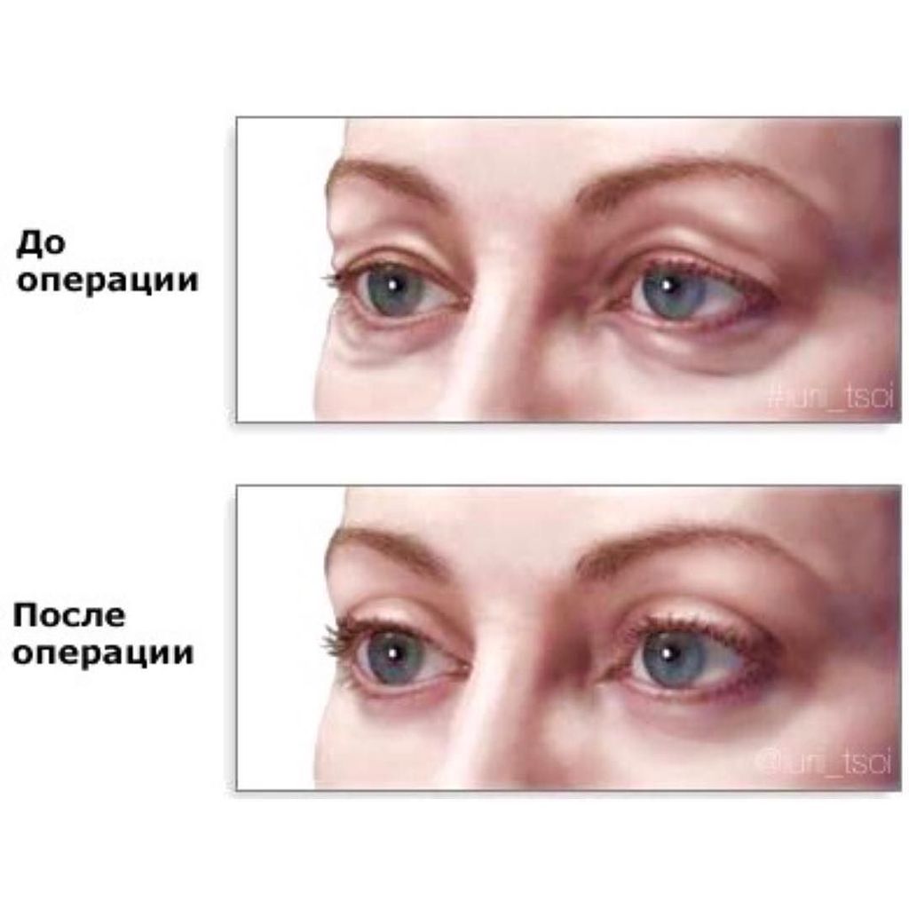 Складки на верхних веках