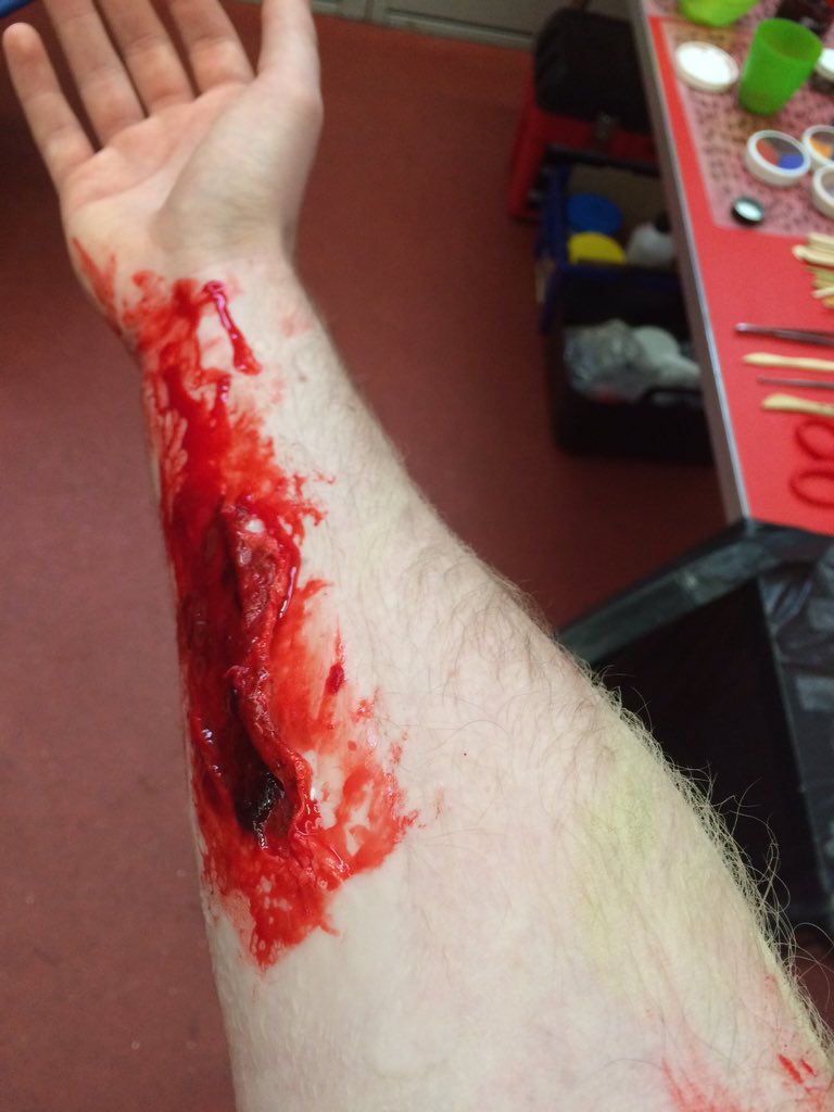 MichaelPenny19's tweet photo. Some lovely injuries courtesy of Paul Savage #epicc15 https://t.co/ODiafCdu9h
