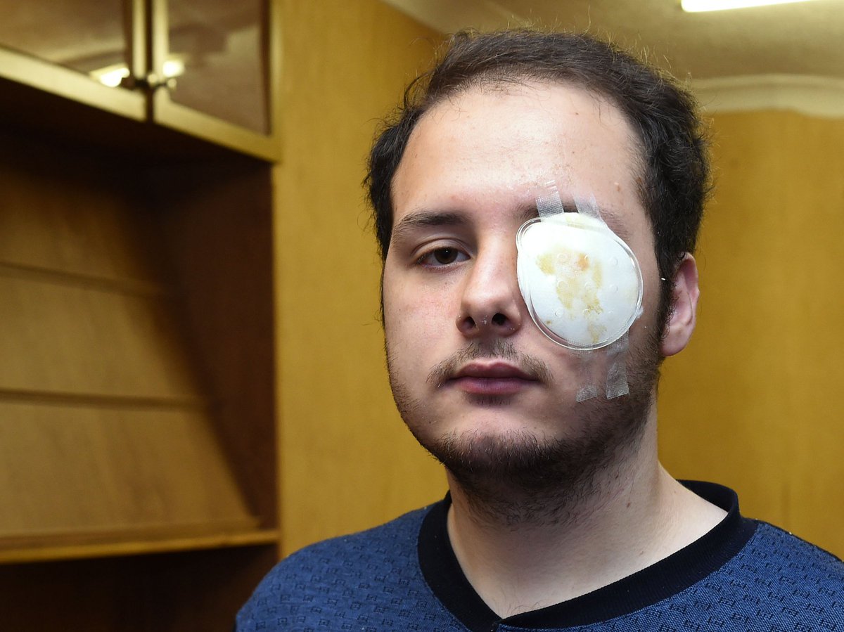 LivEchonews's tweet photo. Teen who lost eye after being hit by firework speaks about freak accident https://t.co/n60yhRw9Co https://t.co/AkozmoQLgt