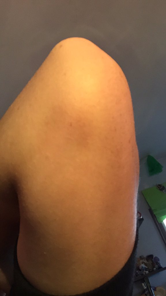 kc_richards6's tweet image. Nothing says welcome back to guard more than weird bruises and broken fingernails 😁 #guardproblems