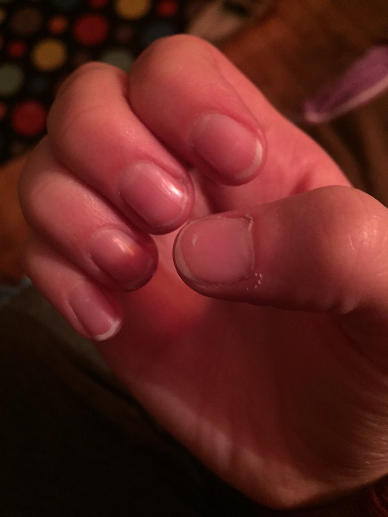 kc_richards6's tweet image. Nothing says welcome back to guard more than weird bruises and broken fingernails 😁 #guardproblems