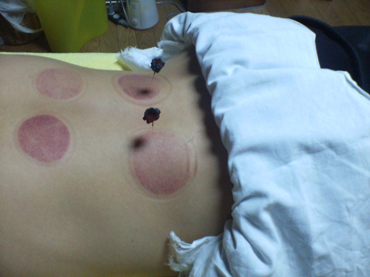 suefalsone's tweet photo. Did you know that #cupping can treat #JoggersHeel and #HamstringStrains? https://t.co/xILy2rpSfR https://t.co/PBwCr5uOYu