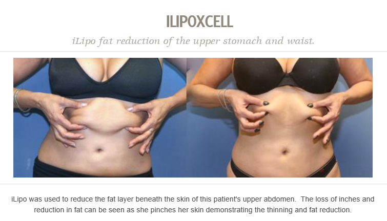 DrJonPerlman's tweet photo. #iLipo was used to reduce the fat layer beneath the skin of this patient's upper abdomen. https://t.co/We9xux08gE