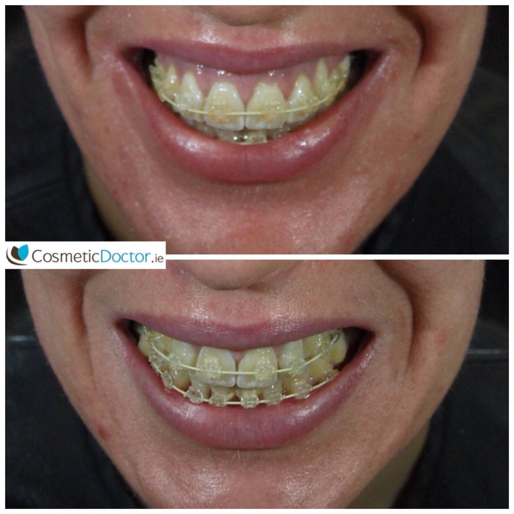 DRLISAFAY's tweet image. Fed up covering your mouth? Gummy smile: One of our before and after photos. #botox #gummysmile.