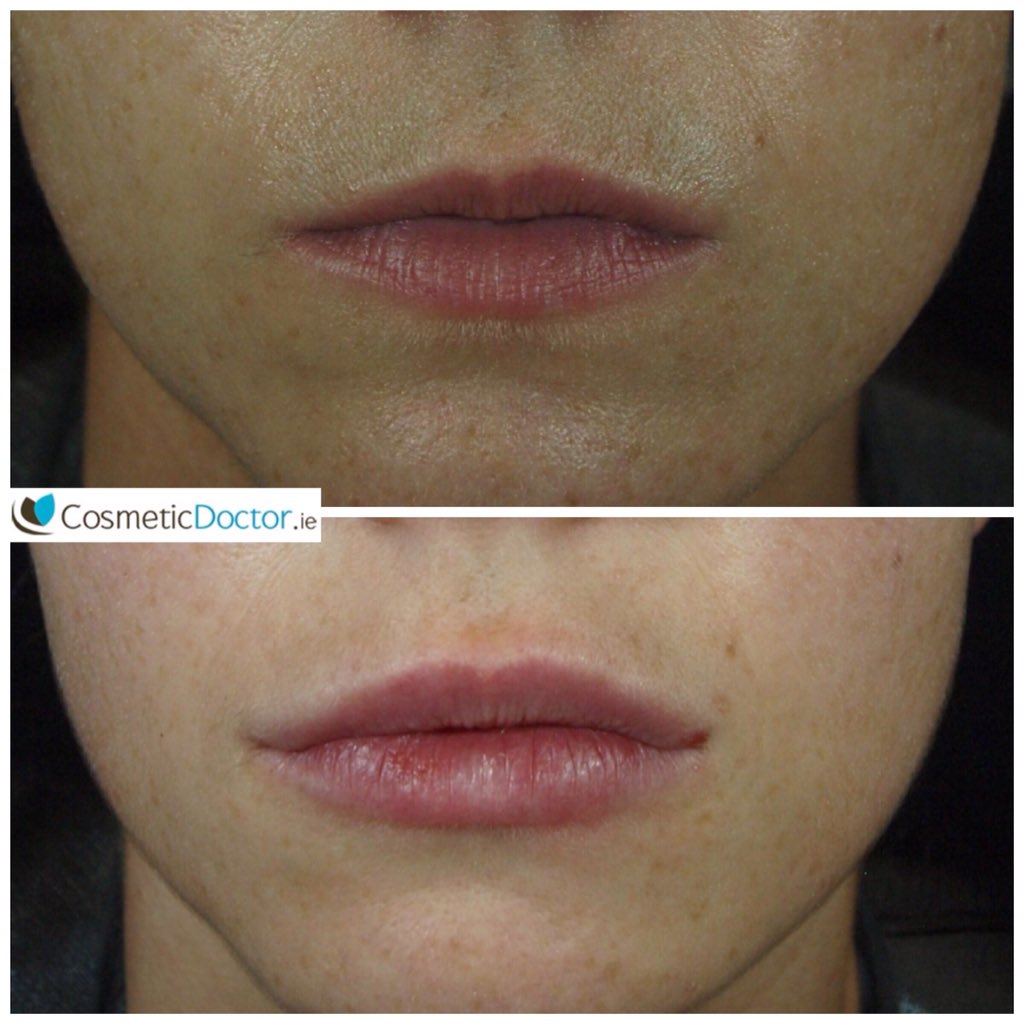 DRLISAFAY's tweet image. Do lip enhancement with dermal fillers &amp;amp; natural results go hand in hand? The answer is YES. #juvederm #lipfillers.