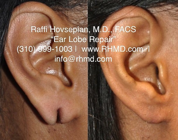 DrHovsepian's tweet photo. Split Ear Lobes? #DrRaffiHovsepian's #EarLobeRepair!
https://t.co/bYdePn2DvU @DrHovsepian #EarLobeSurgery #SplitEar https://t.co/gU96xcSrs2