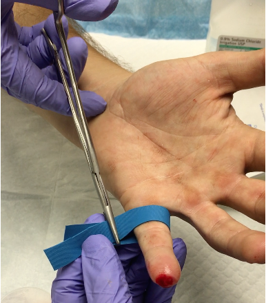 ALiEMteam's tweet photo. Trick of Trade: Dermal Avulsion Injuries 2.0 by @BWLin720 | Expert PR by @RobJBryant13 https://t.co/uaNvxpufhp https://t.co/33csqmm7Bl